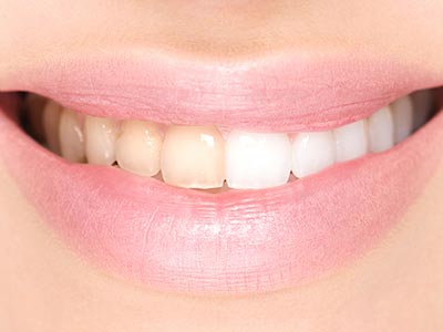 Sbiancamento dentale